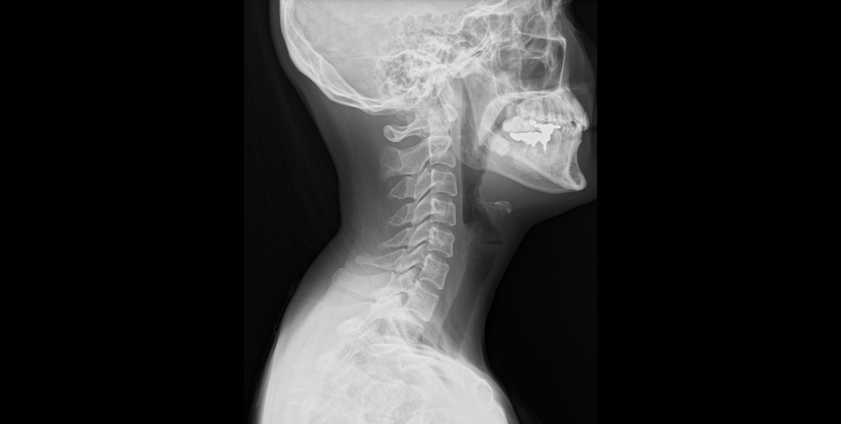 頚椎側面 神川カイロプラクティック